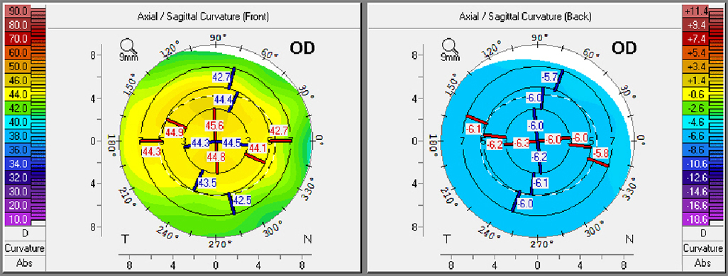 corneal surface after treatment