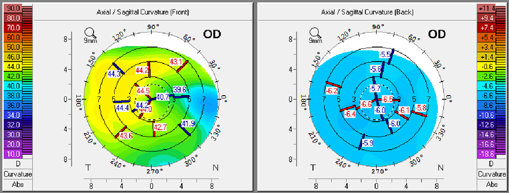 irregular corneal surface